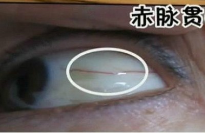 钟修梅目诊：赤脉贯瞳是重病的表现